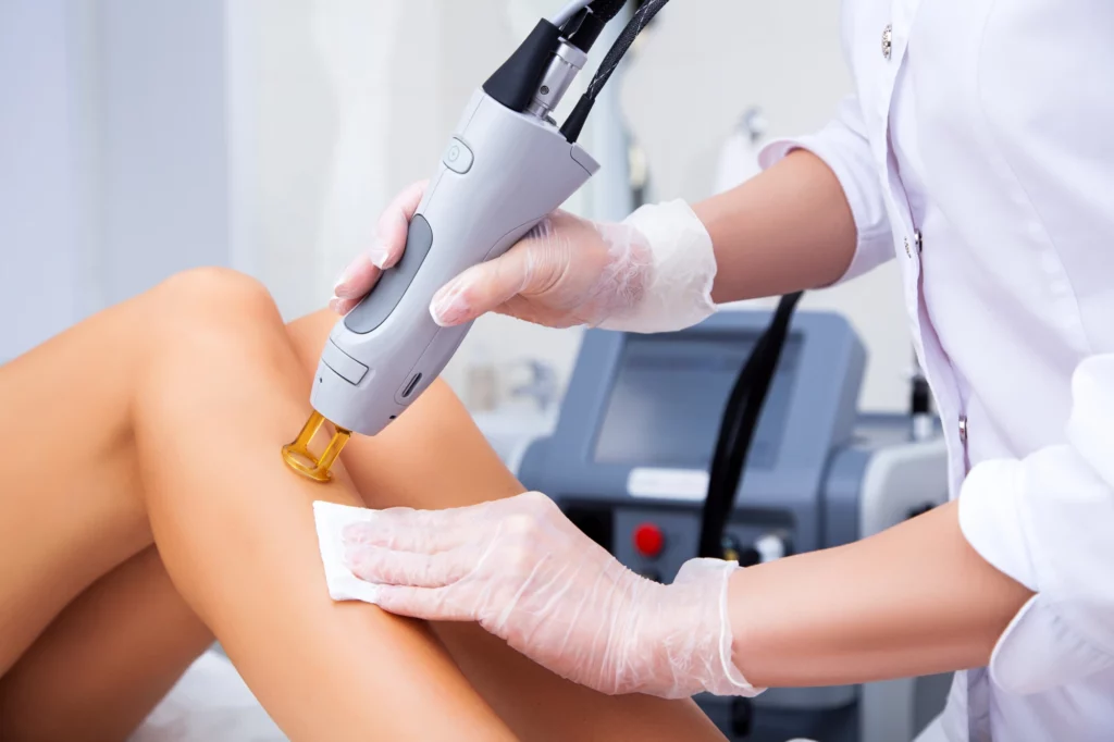 Leg Vein Removal