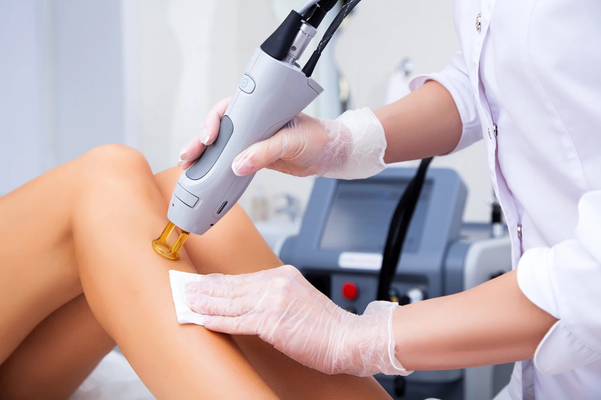 Leg Vein Removal